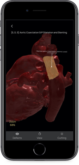 App evidenzia sezione del cuore 3D soggetta a difetti App evidenzia sezione del cuore 3D soggetta a difetti