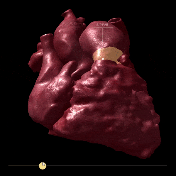 Cuore sezionato in realtà aumentata Cuore sezionato in realtà aumentata
